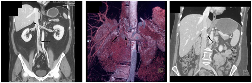 IVC stents and filters